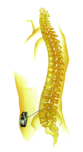 In vivo implantation of the pump (schematic diagram)